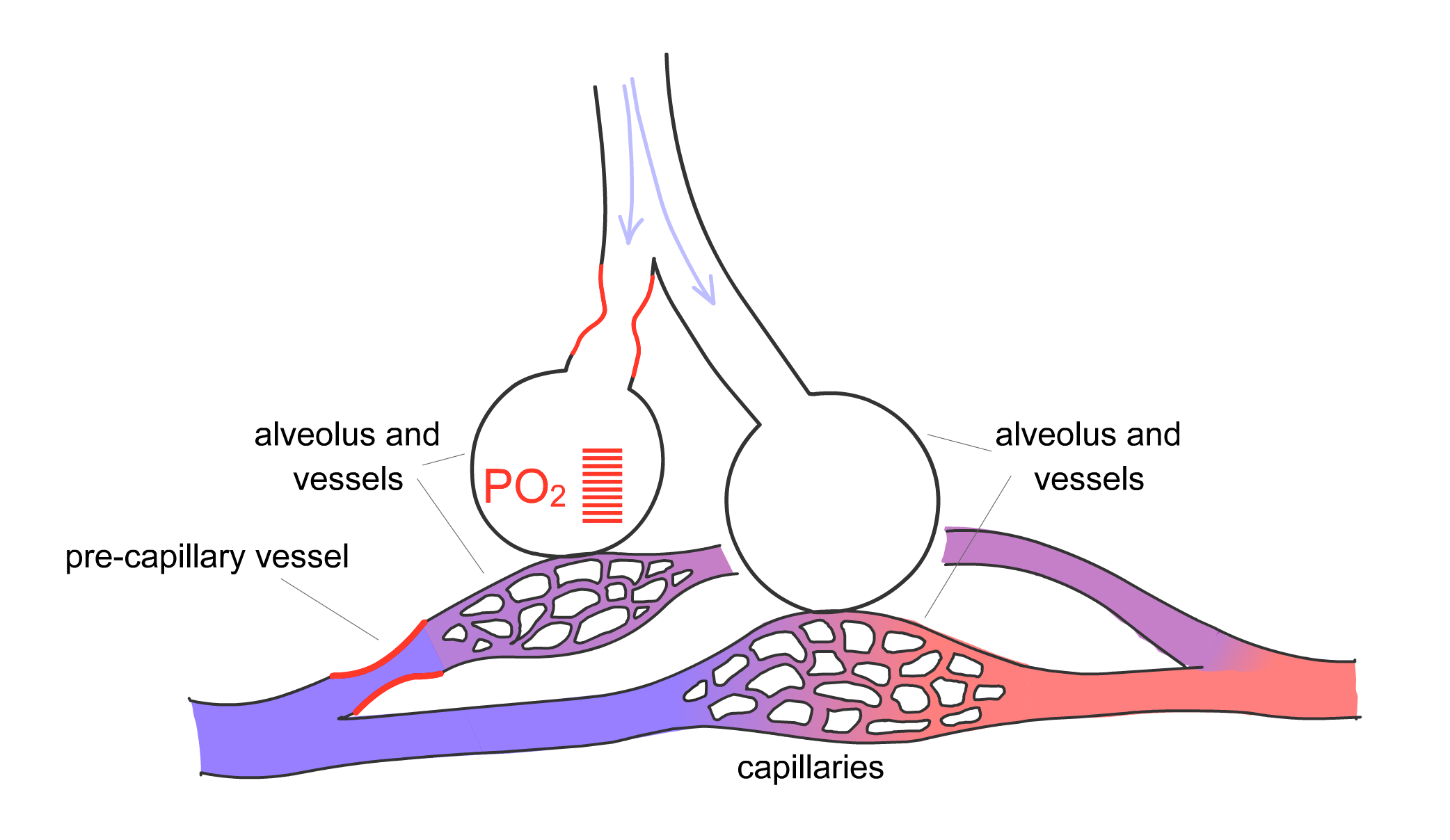 Moderate obstruction to one alveoli with resulting hypoxic vasoconstriction