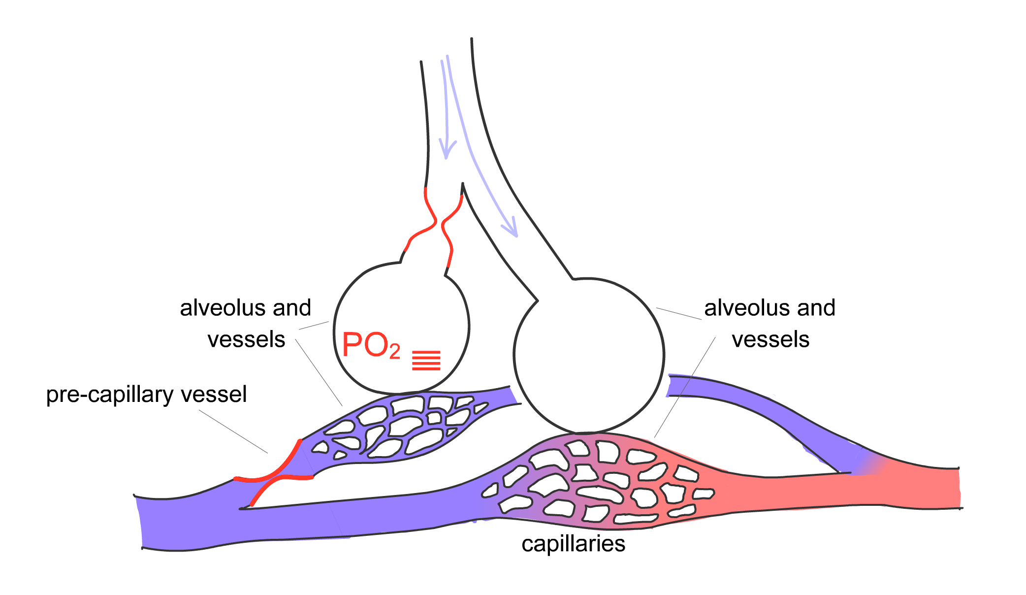 Significant obstruction to one alveoli with greater hypoxic vasoconstriction
